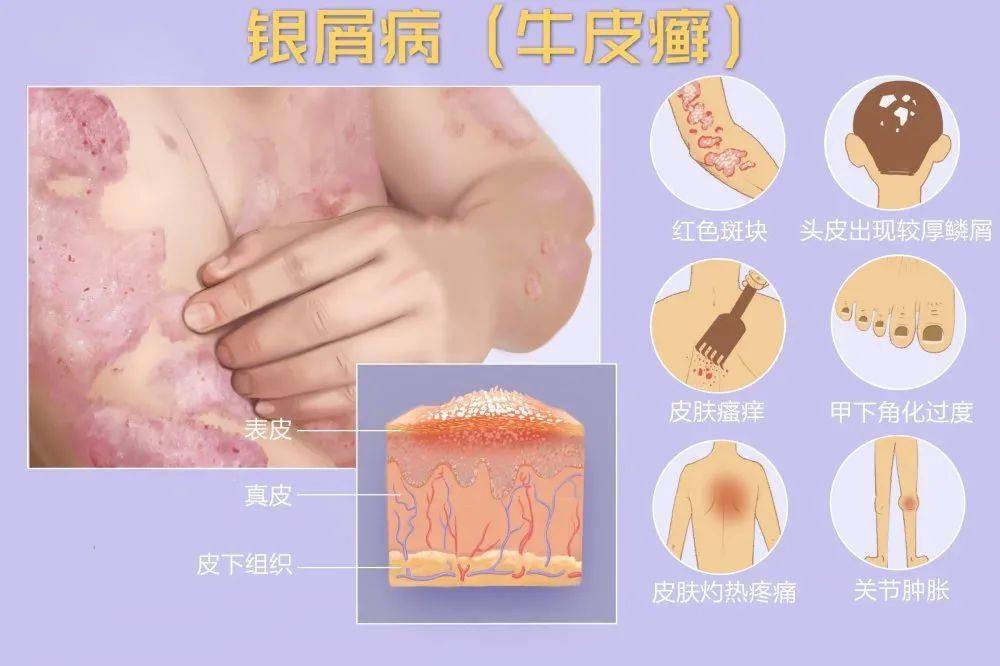 科普小常识关于银屑病所有疑问答案全在这里