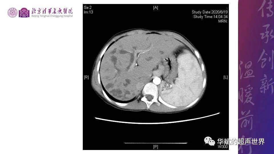 病例讨论与文献学习caroli病caroli综合征