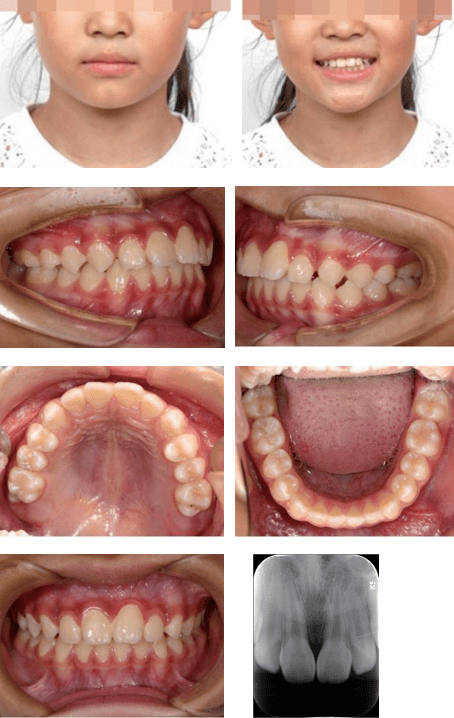 5个月后,上颌固定矫治器排齐上牙列图5戴口内牵引装置(改良nance弓