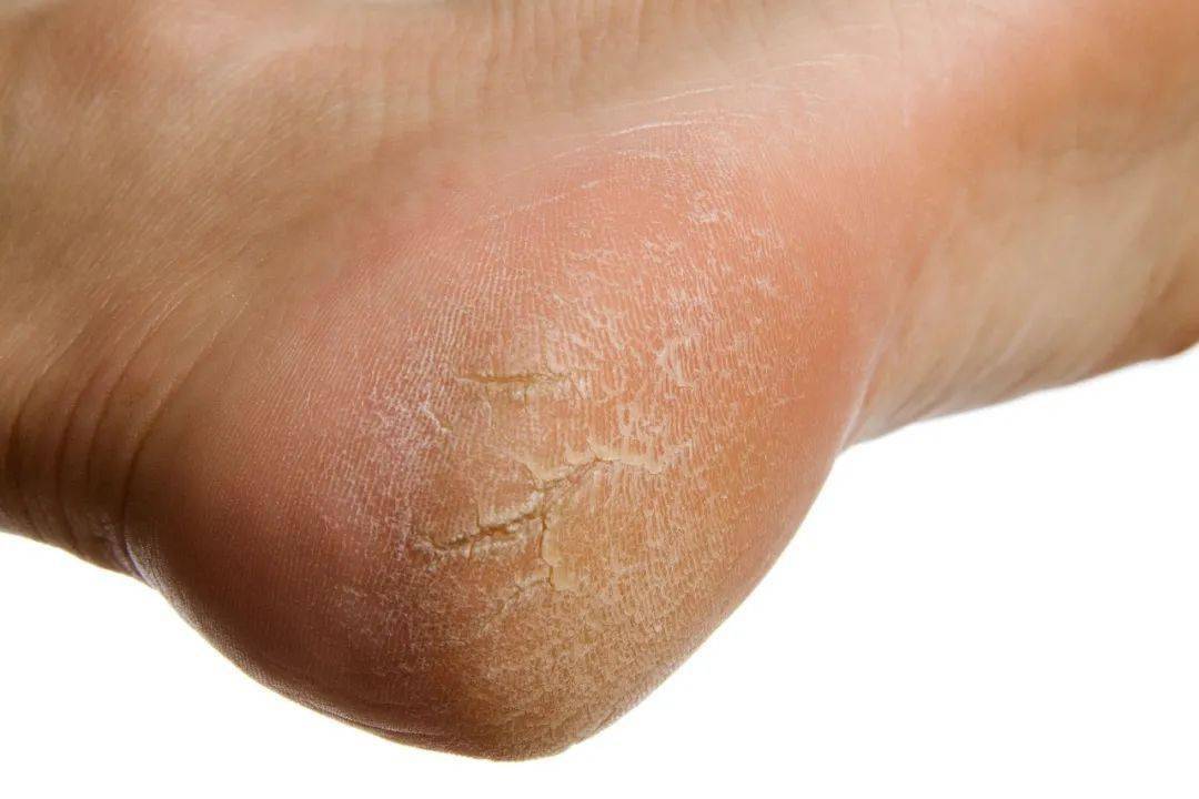 是造成脚干裂的常见原因,这主要与分布在脚后跟附近的皮肤汗腺少有关