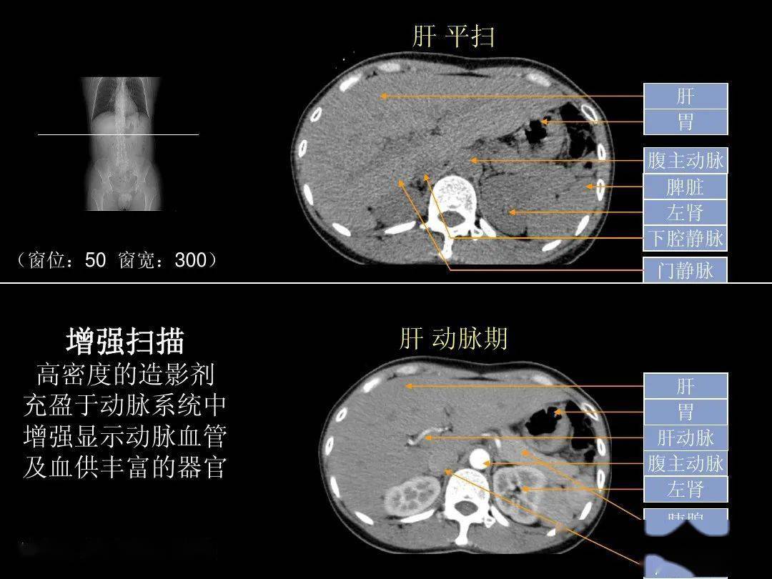 腹部ct入门解剖图谱收藏版