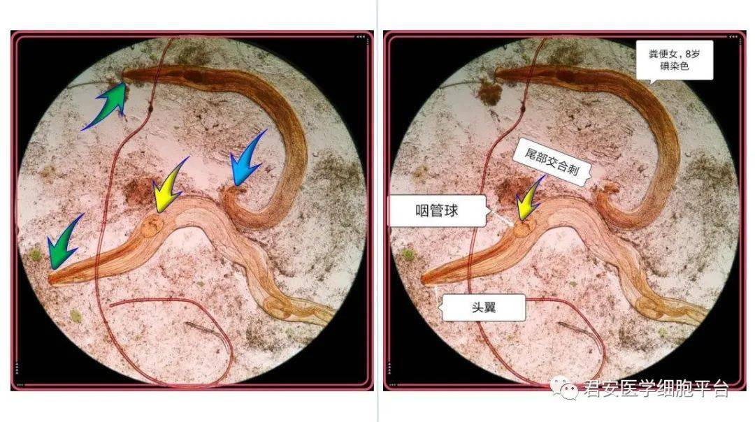 蛲虫及其虫卵之美图
