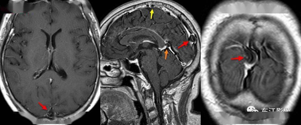 入门必读头颅mri易误诊影像赶紧收藏