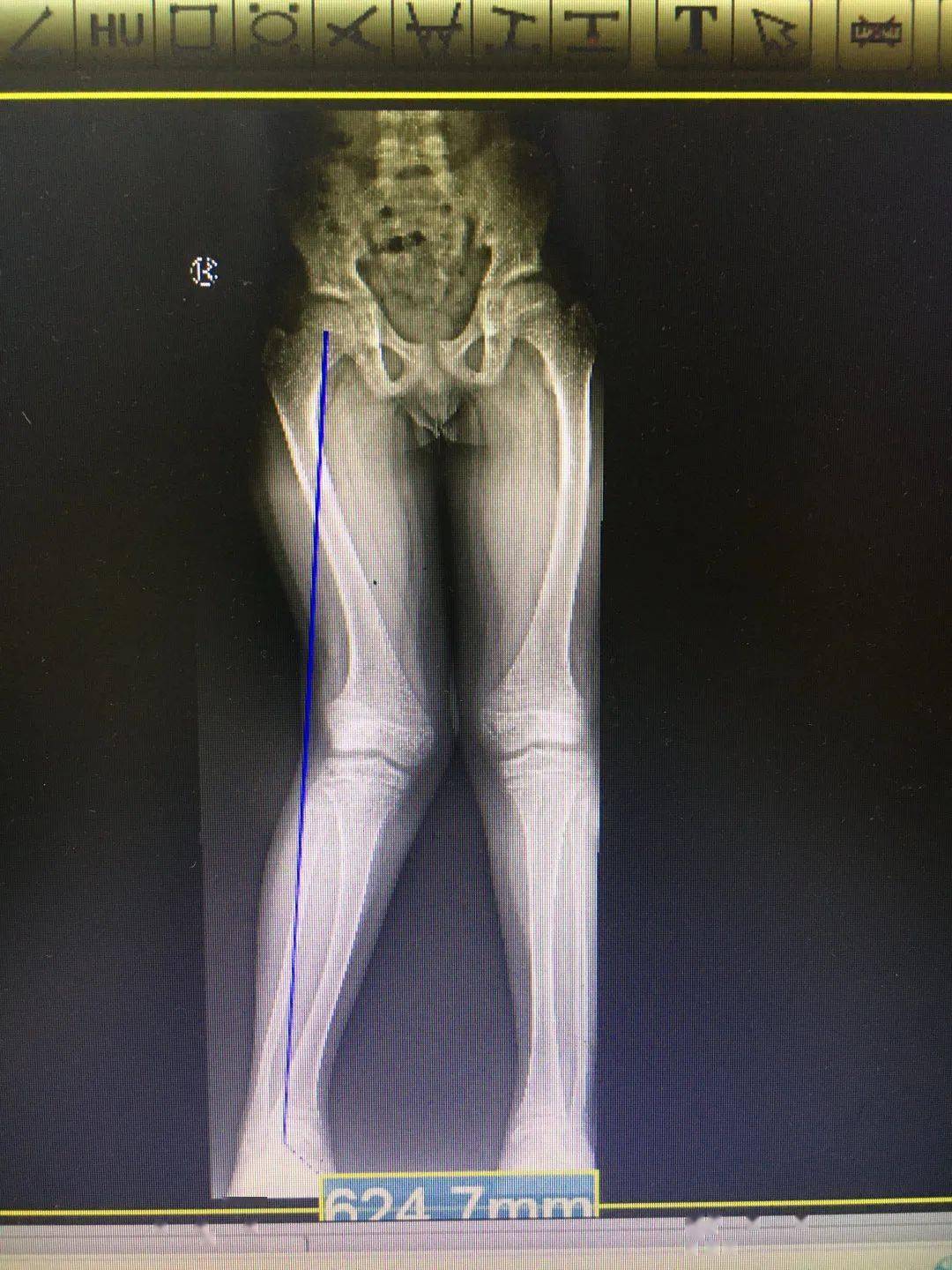 为了让罗圈腿变直少女遭受8处断骨之痛医生早矫正不用遭那么多罪