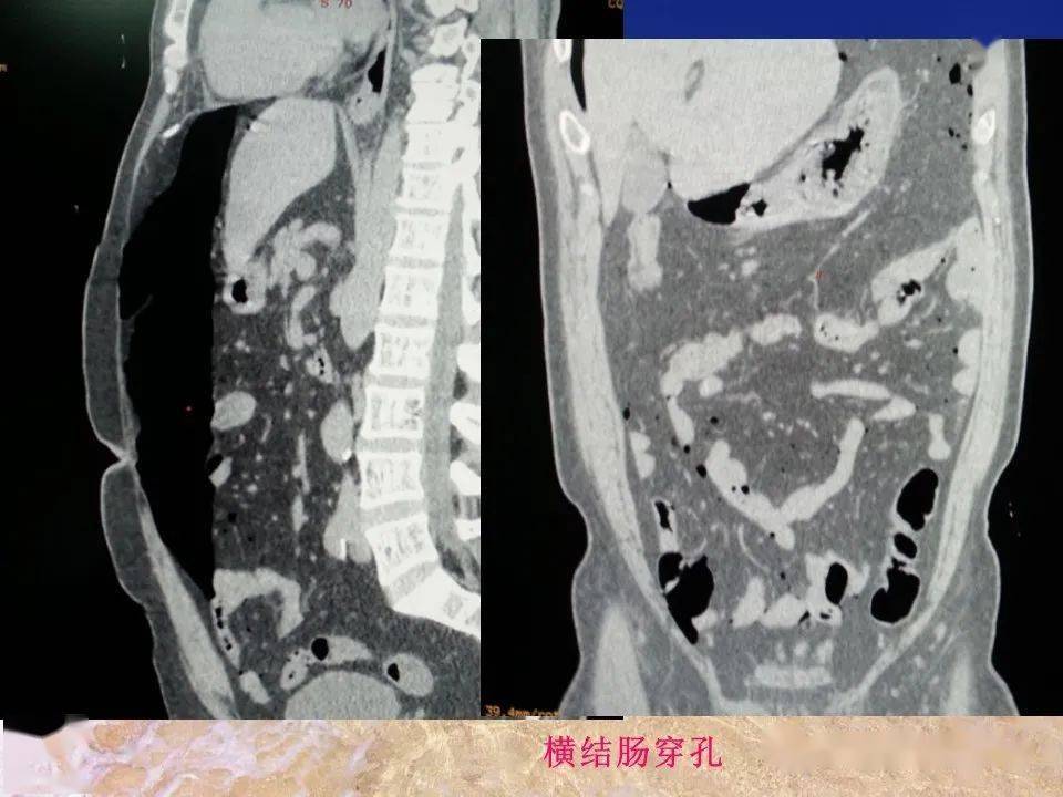 消化道穿孔的ct診斷