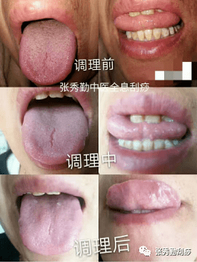 全息刮痧调养先天之本