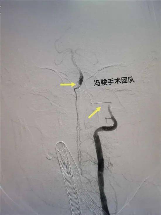 椎动脉阻力指数增高图片