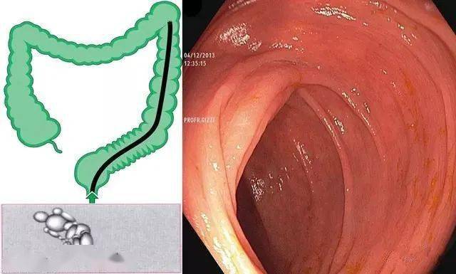 操作法》/endoscopy-colon-explorer 网站)横结肠特点:可见三角形皱襞