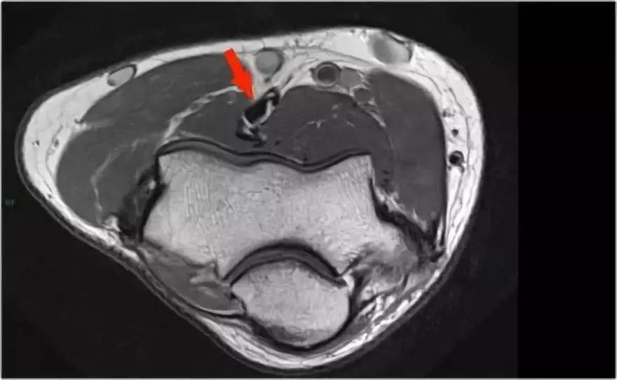 肘關節mr解剖及疾病詳解