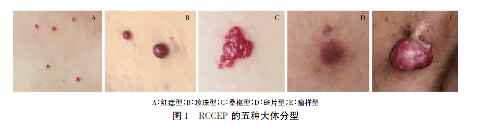 或桑椹型部分「红痣型」可逐步发展为「珍珠样」结节(颜色鲜红或暗红