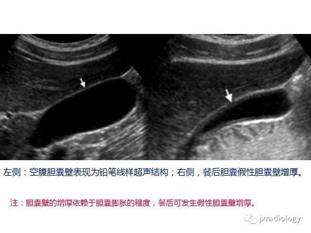 胆囊壁增厚的影像鉴别诊断