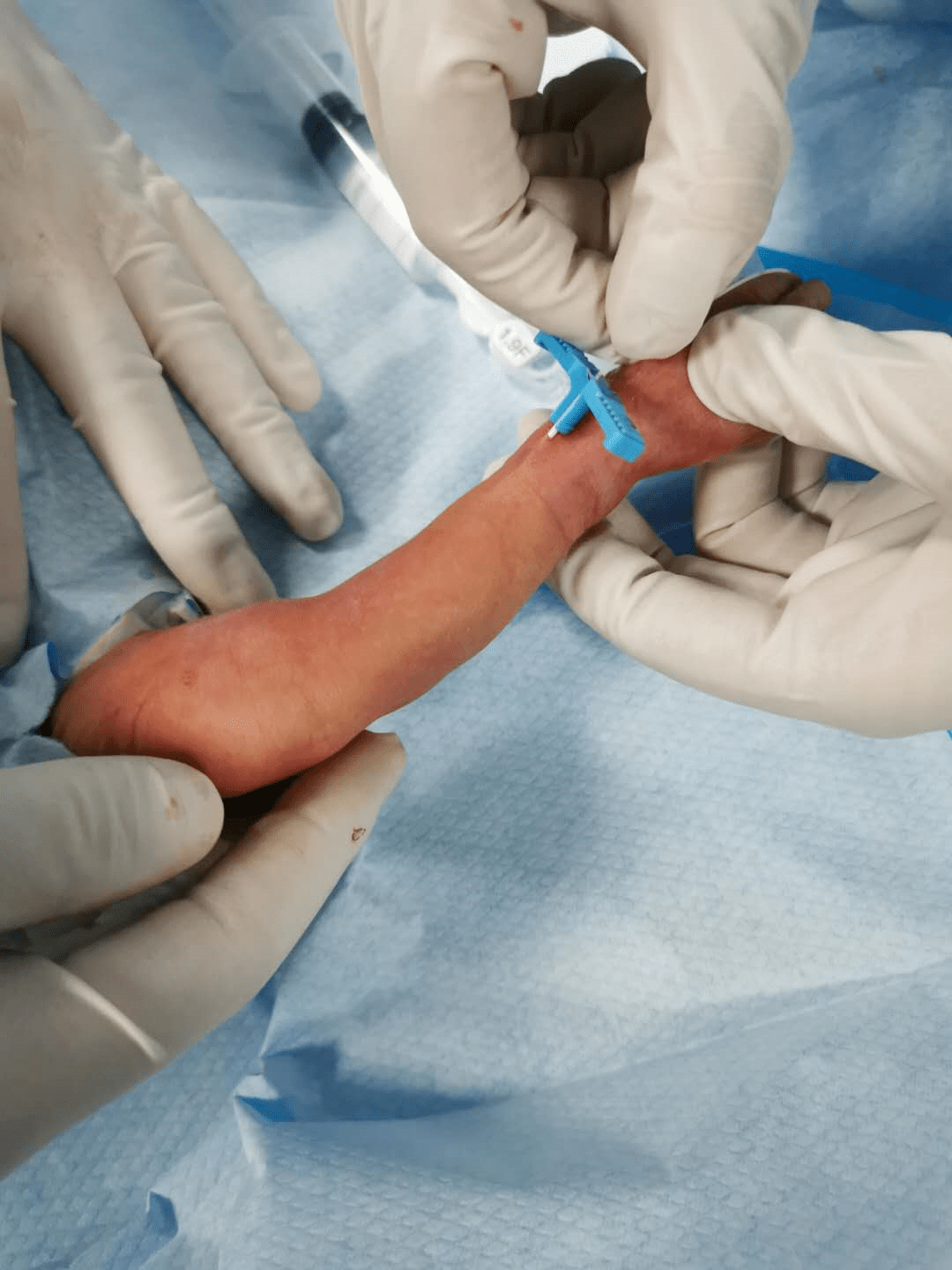 新生儿室为1.4kg迷你宝宝成功置入picc