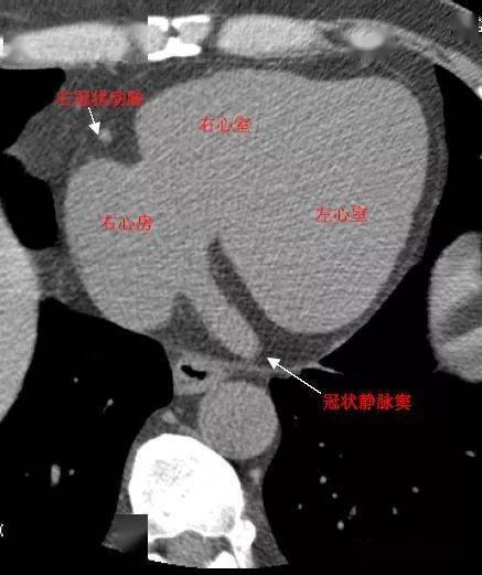 影像解剖 | 心脏冠状动脉ct解剖中文详细标注(图文)_相册