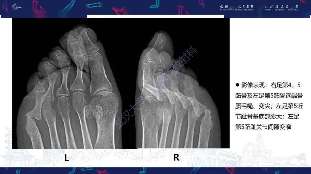 银屑病关节炎影像诊断