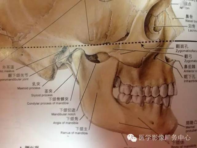茎突舌骨韧带钙化图片