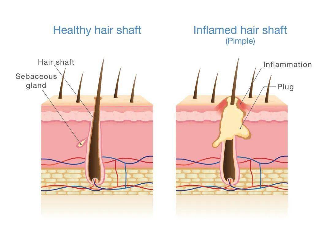 而真菌感染毛发和头皮则引起头癣,不仅引起断发和脱发,还可