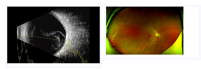 右眼颞侧偏盲,双眼屈光不正左眼玻璃体积血,视网膜牵拉,根据检查结果