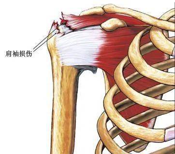 甚至可将骨性肩胛盂也撕下一块,形成骨性盂唇损伤,撕裂的盂唇关节囊