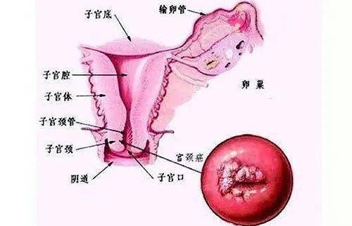 宫颈在哪个位置图片图片