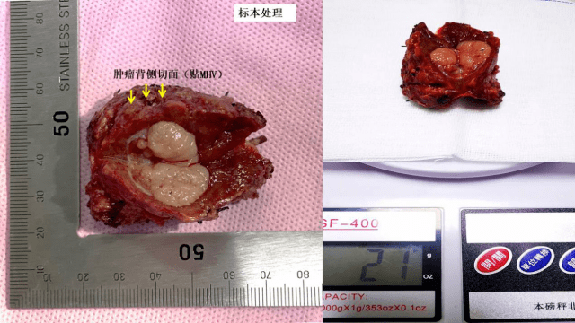 手术切面相同患者卓玛是一名70岁女性,因为腹痛行ct提示左肝2cm小肝癌