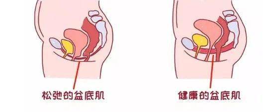 盆底肌所受压力越来越大,盆底肌肉会逐渐松弛女性在怀孕的过程中,随着