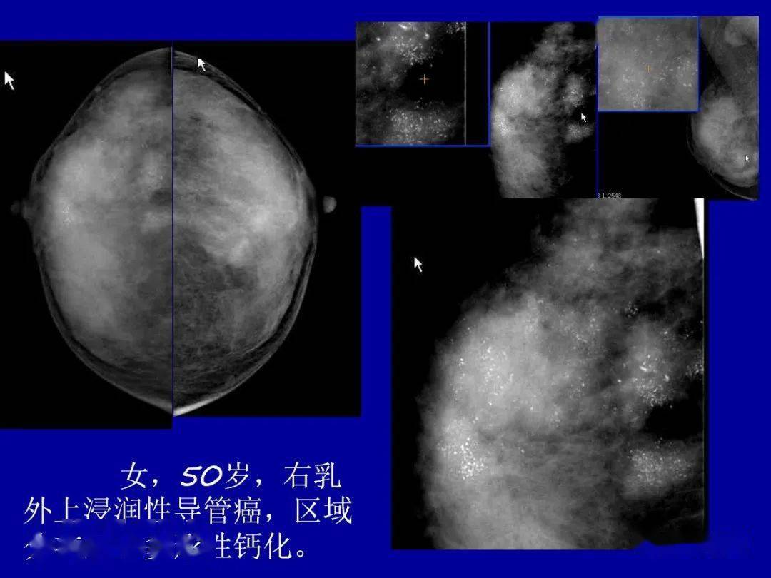 paget乳腺癌图片图片