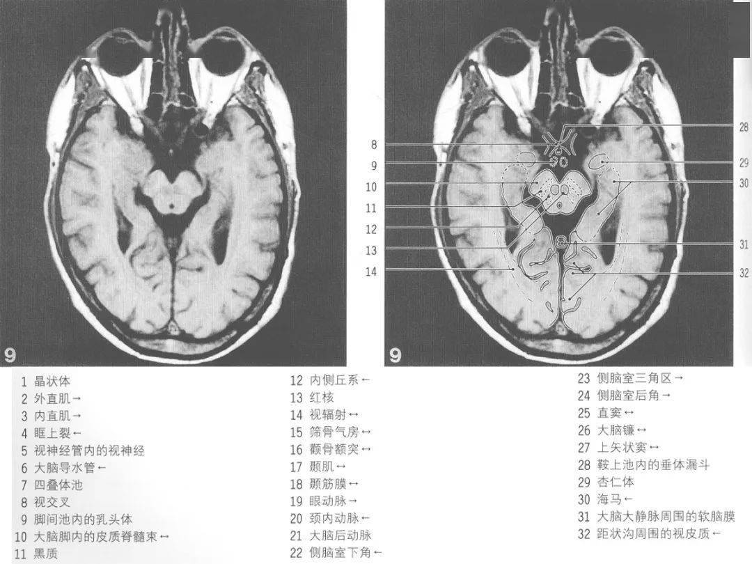 核磁头颅解剖图图片
