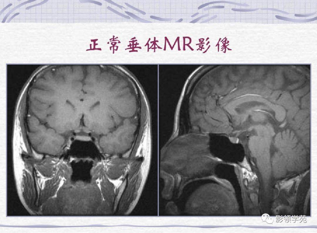 垂体解剖结构 MRI图片