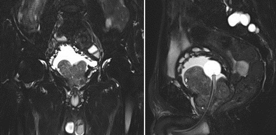 前列腺增生CT图片
