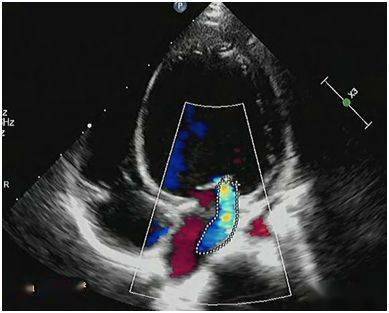 心内膜胶原弹力纤维增生症 (endocardial fibroelastosis,efe) 是指心