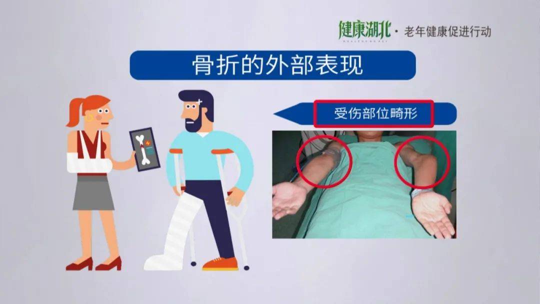 (4)肱骨近端骨折,是上臂靠近肩关节的部分.