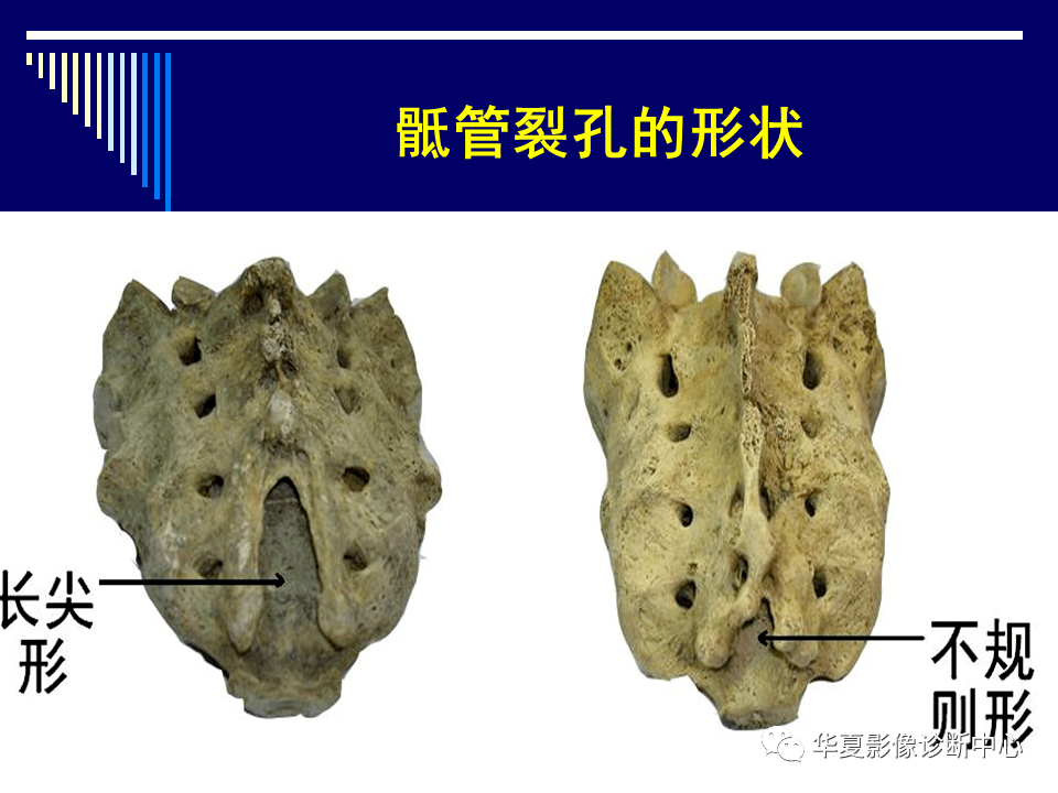 经典课件影像那些需要知道系列骶骨的解剖学变异