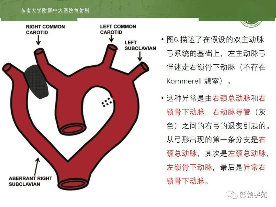 血流梗阻分為梗阻性先天性主動脈弓畸形和非梗阻性先天性主動脈弓畸形