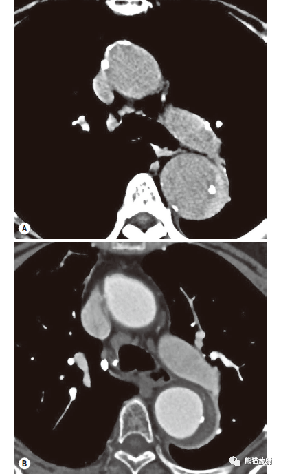 格艾選讀丨獲得性主動脈異常機理ct表現鑑別診斷
