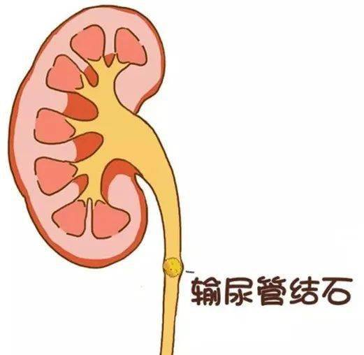心里的石头终于落地了记龙岩院区泌尿外科输尿管结石取出术