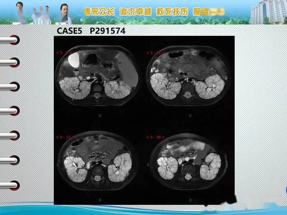 髓质海绵肾的影像诊断