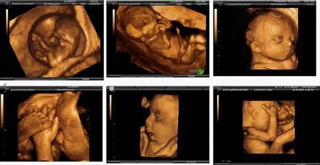 而彩色b超就像彩色照片,三维b超就像是立体彩色照片,四维b超则像是