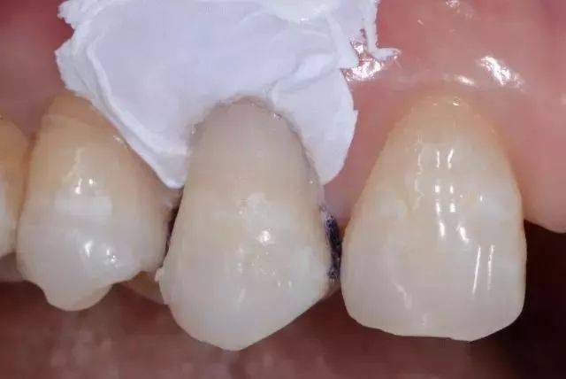 楔状缺损是牙齿颈部硬组织缓慢消耗而形成的缺损,呈"v"状,由于它的