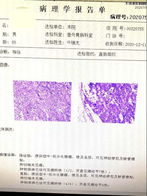 附属和济医院胃肠外科自主开展2例复杂结直肠肿瘤腹腔镜手术治疗