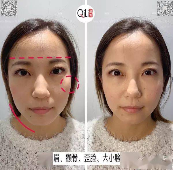 日式徒手整骨小颜术