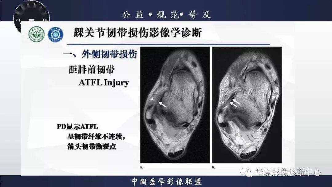 踝關節解剖及損傷mri診斷