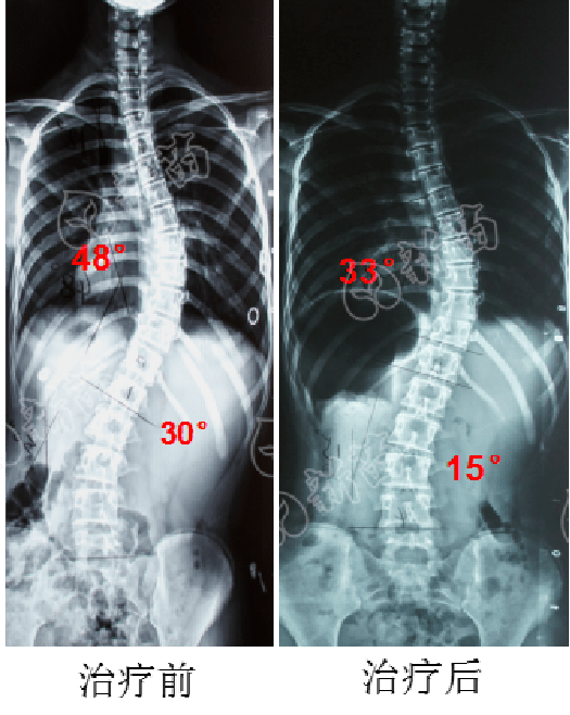 保守案例通过努力13岁女孩48侧弯锐减15成功避免开刀