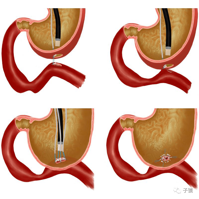 食管空肠吻合术示意图图片