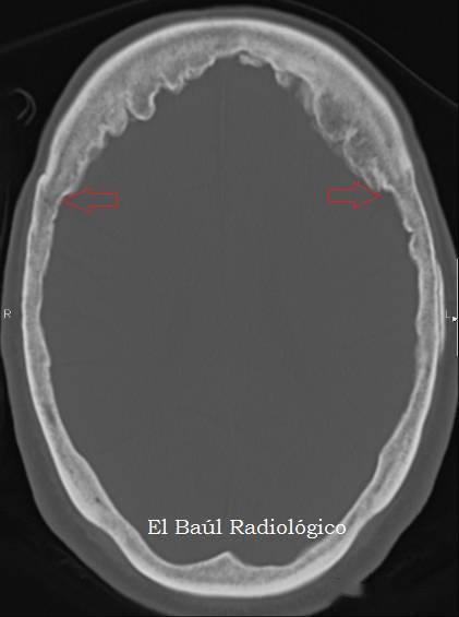 額骨內板增生症(hyperostosis frontalis interna,hfi)