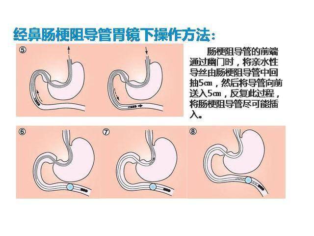 肠梗阻导管 工作原理图片