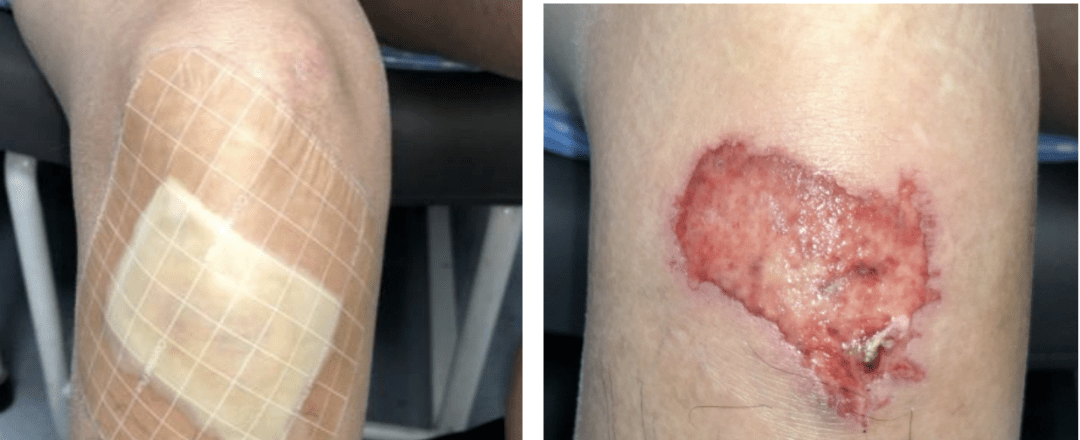 皮肤伤口包扎vs暴露如何选一个案例教你掌握