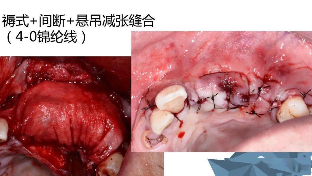 牙科常用缝合方式