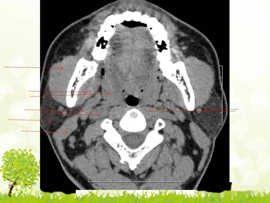 咽旁间隙解剖及常见病变影像表现