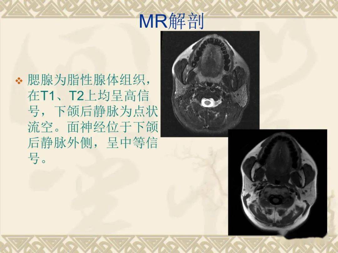 腮腺解剖及病变影像学表现