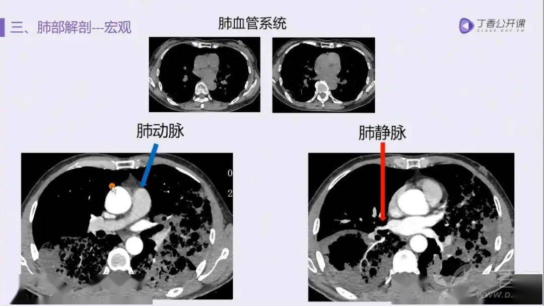 肺的五叶十八段解剖基础及 CT 病灶识别要点_支气管